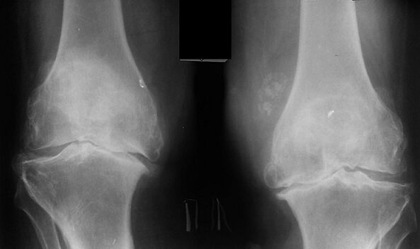 X -Ray ως μέσο διάγνωσης της οστεοαρθρίτιδας της άρθρωσης του γόνατος