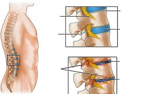 Η οστεοχόνδρωση της οσφυϊκής μοίρας της σπονδυλικής στήλης προκαλεί πόνο στην πλάτη